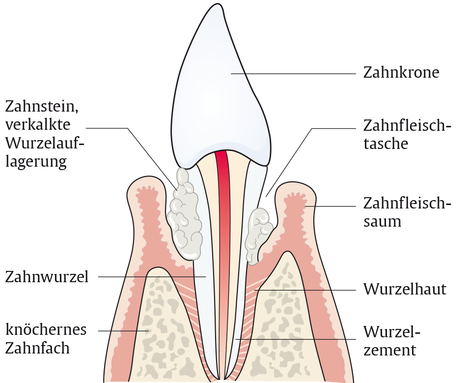 Parodontitis